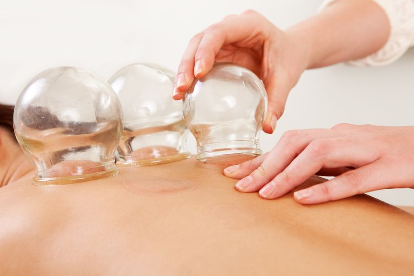 Notaro Chiropractic Cupping